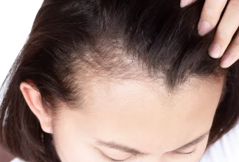 derma-rolling-for-hair-loss-featured