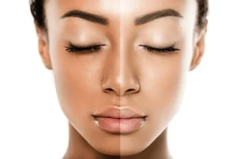 skin-whiteing-treatment-in-delhi-n